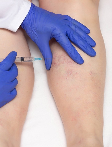 vein procedures@1.2x